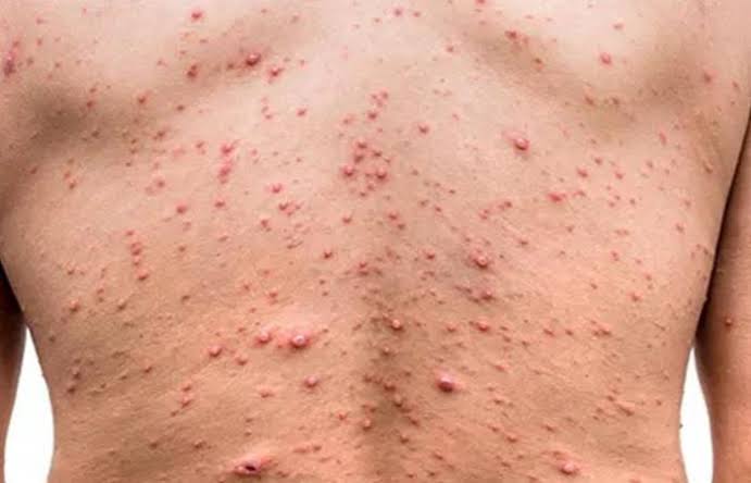 As infections spread, WHO says Monkeypox not yet global health emergency