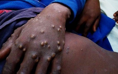 Anambra records two cases of Monkey Pox