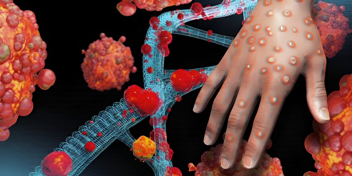 Mpox: What you need to know about rampaging disease