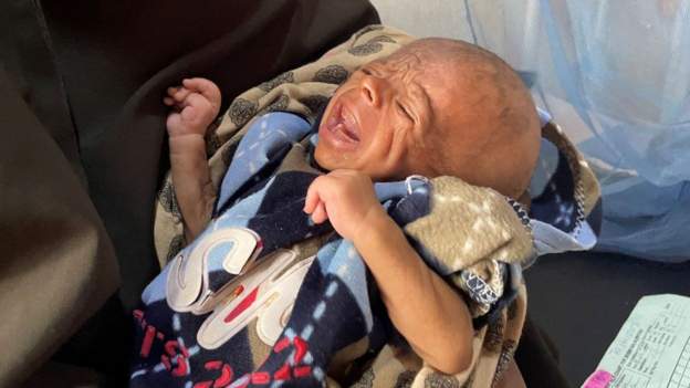 Ten million East African children hit by malnutrition - report