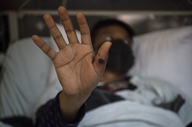 Monkeypox Cases Top 70,000 "“ WHO