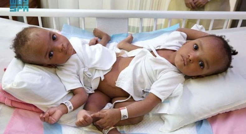 Conjoined Nigerian twins successfully separated in Saudi Arabia