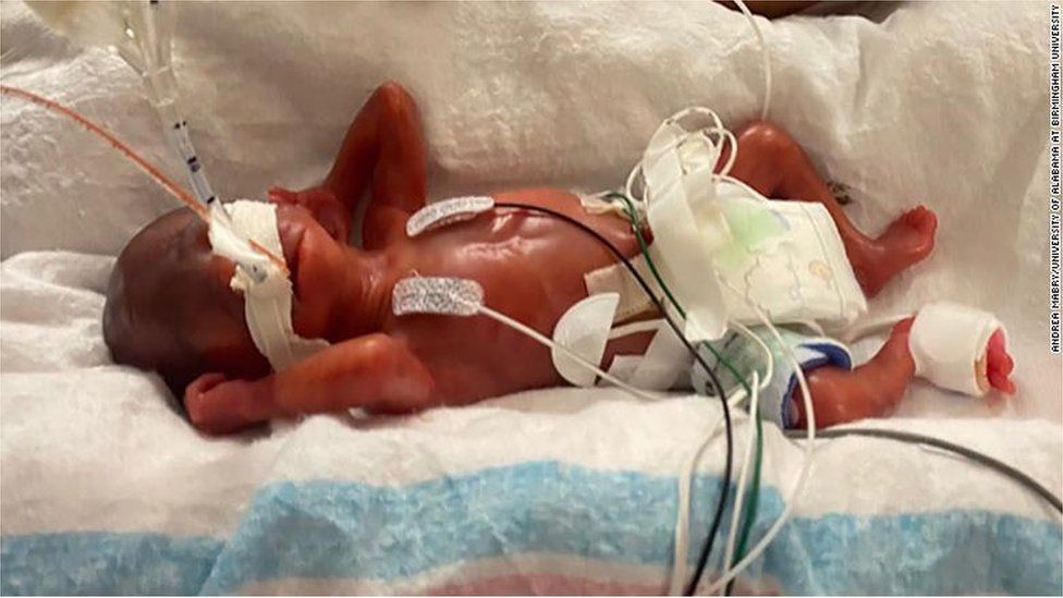 Alabama boy certified as world's most premature baby